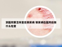 到医院要怎样查出银屑病 银屑病在医院应做什么检查