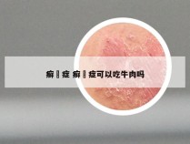 癣蔴症 癣蔴症可以吃牛肉吗