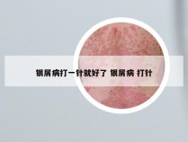 银屑病打一针就好了 银屑病 打针