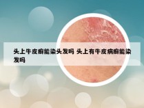 头上牛皮癣能染头发吗 头上有牛皮病癣能染发吗