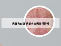 头部有白斑 头部有白斑治得好吗