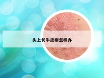 头上长牛皮癣怎样办