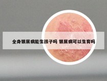 全身银屑病能生孩子吗 银屑病可以生育吗