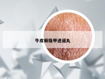 牛皮癣指甲逍遥丸