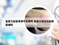 免疫力低容易得牛皮癣吗 免疫力低会引起银屑病吗
