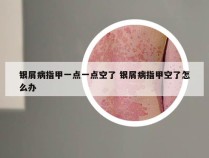 银屑病指甲一点一点空了 银屑病指甲空了怎么办