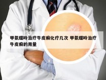 甲氨蝶呤治疗牛皮癣化疗几次 甲氨蝶呤治疗牛皮癣的用量