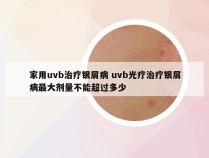家用uvb治疗银屑病 uvb光疗治疗银屑病最大剂量不能超过多少