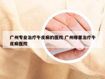 广州专业治疗牛皮癣的医院 广州哪里治疗牛皮癣医院