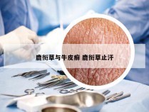 鹿衔草与牛皮癣 鹿衔草止汗