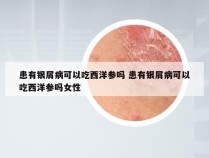 患有银屑病可以吃西洋参吗 患有银屑病可以吃西洋参吗女性