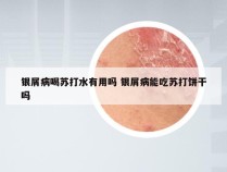 银屑病喝苏打水有用吗 银屑病能吃苏打饼干吗