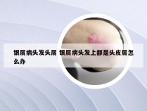 银屑病头发头屑 银屑病头发上都是头皮屑怎么办