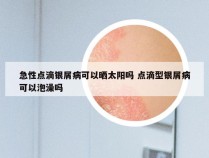 急性点滴银屑病可以晒太阳吗 点滴型银屑病可以泡澡吗