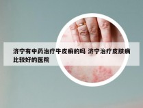 济宁有中药治疗牛皮癣的吗 济宁治疗皮肤病比较好的医院