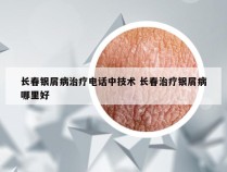 长春银屑病治疗电话中技术 长春治疗银屑病哪里好