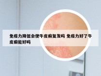 免疫力降低会使牛皮癣复发吗 免疫力好了牛皮癣能好吗