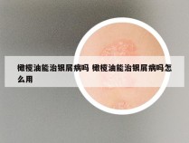 橄榄油能治银屑病吗 橄榄油能治银屑病吗怎么用