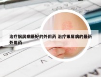 治疗银屑病最好的外用药 治疗银屑病的最新外用药