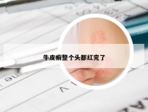 牛皮癣整个头都红完了