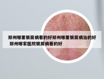 郑州哪里银屑病看的好郑州哪里银屑病治的好 郑州哪家医院银屑病看的好