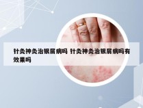 针灸神灸治银屑病吗 针灸神灸治银屑病吗有效果吗