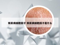 银屑病细胞因子 银屑病细胞因子是什么