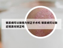银屑病可以做视力矫正手术吗 银屑病可以做近视激光矫正吗