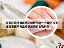 石家庄治疗银屑病正规医院哪一个最好 石家庄哪家医院有治疗银屑病的生物制剂