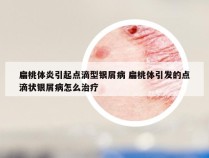 扁桃体炎引起点滴型银屑病 扁桃体引发的点滴状银屑病怎么治疗