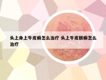 头上身上牛皮癣怎么治疗 头上牛皮肤癣怎么治疗