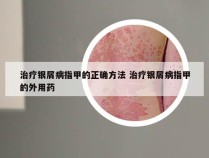 治疗银屑病指甲的正确方法 治疗银屑病指甲的外用药