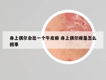 身上偶尔会出一个牛皮癣 身上偶尔痒是怎么回事