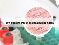 买了大病险牛皮癣算 银屑病买保险要告知吗