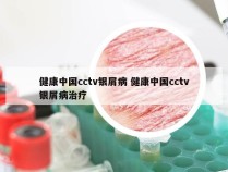 健康中国cctv银屑病 健康中国cctv银屑病治疗