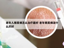 老年人银屑病怎么治疗最好 老年银屑病涂什么药好