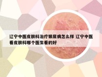 辽宁中医皮肤科治疗银屑病怎么样 辽宁中医看皮肤科哪个医生看的好