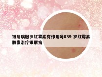 银屑病服罗红霉素有作用吗039 罗红霉素胶囊治疗银屑病