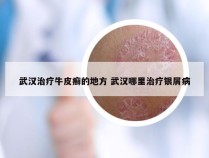 武汉治疗牛皮癣的地方 武汉哪里治疗银屑病