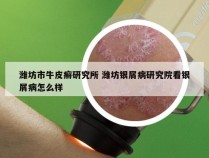 潍坊市牛皮癣研究所 潍坊银屑病研究院看银屑病怎么样
