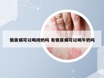 银屑病可以喝纯奶吗 有银屑病可以喝牛奶吗