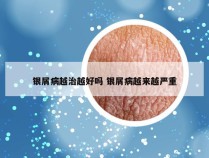 银屑病越治越好吗 银屑病越来越严重