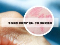 牛皮癣指甲病变严重吗 牛皮肤癣的指甲