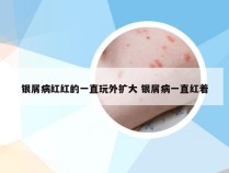 银屑病红红的一直玩外扩大 银屑病一直红着