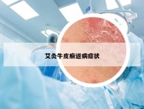艾灸牛皮癣返病症状