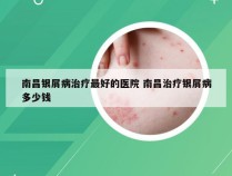 南昌银屑病治疗最好的医院 南昌治疗银屑病多少钱