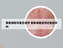 银屑病后天是否遗传 银屑病是遗传还是后天的
