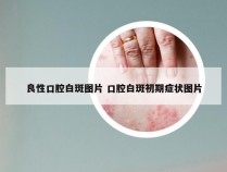 良性口腔白斑图片 口腔白斑初期症状图片