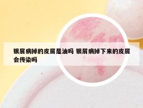 银屑病掉的皮屑是油吗 银屑病掉下来的皮屑会传染吗
