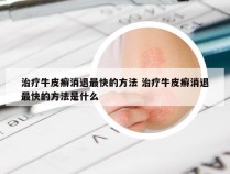治疗牛皮癣消退最快的方法 治疗牛皮癣消退最快的方法是什么